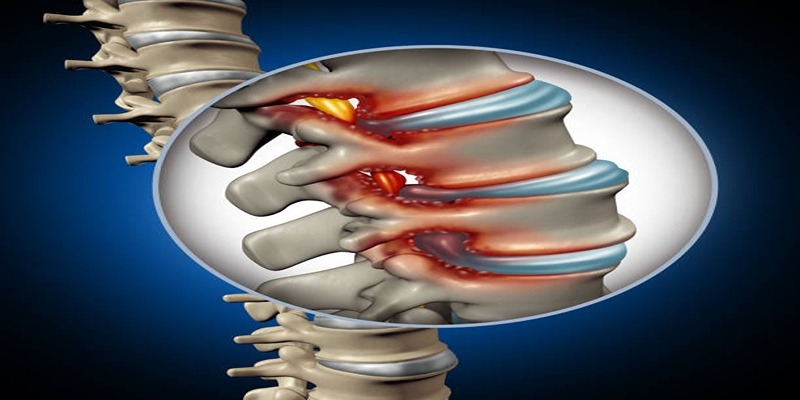 Warning Signs of Spinal Stenosis You Should Know