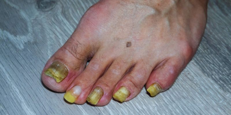 Understanding the Warning Signs of Onychomycosis: A Complete Guide 